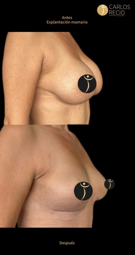 Beneficios de la explantación mamaria Beneficios de la explantación mamaria